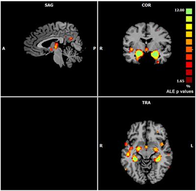 The Pathoconnectivity Profile of Alzheimer’s Disease: A Morphometric Coalteration Network Analysis